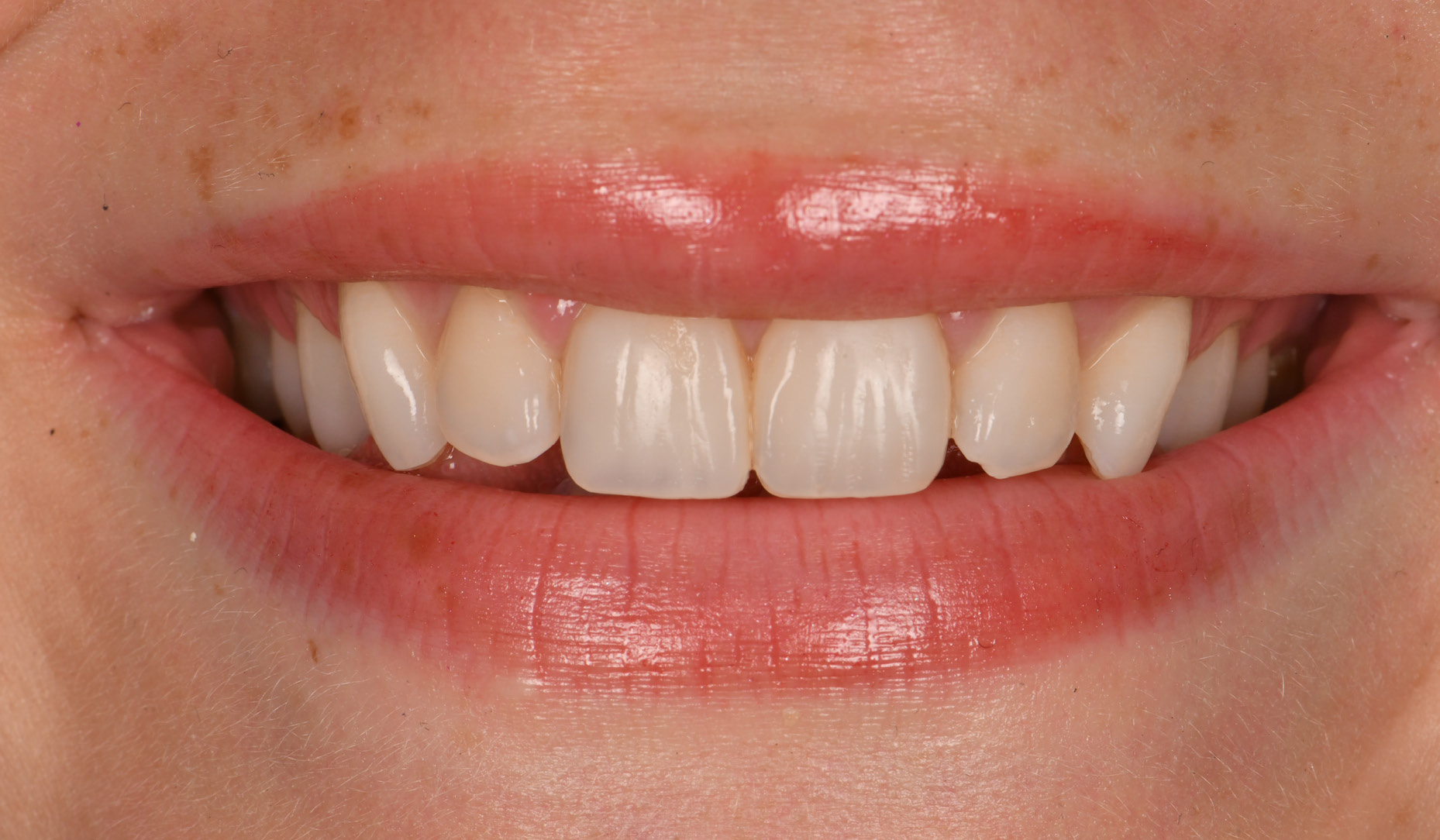 Figure 5: Final immediate post-operative result after finishing and polishing.